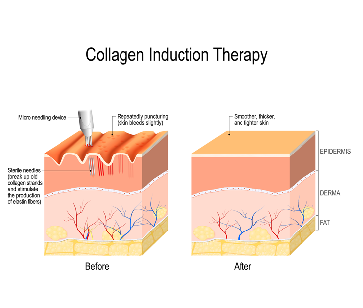 Illustrazione del meccanismo d’azione dell’acido polilattico e stimolazione del collagene