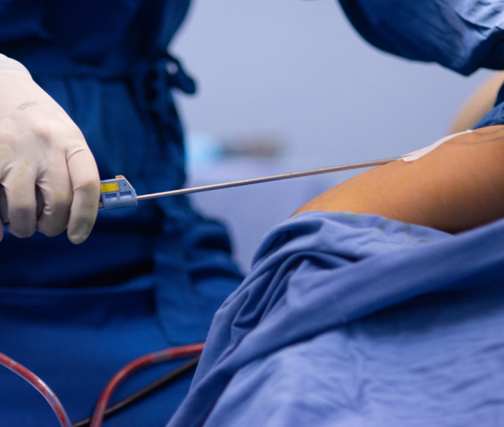 Valutazione per liposcultura estesa